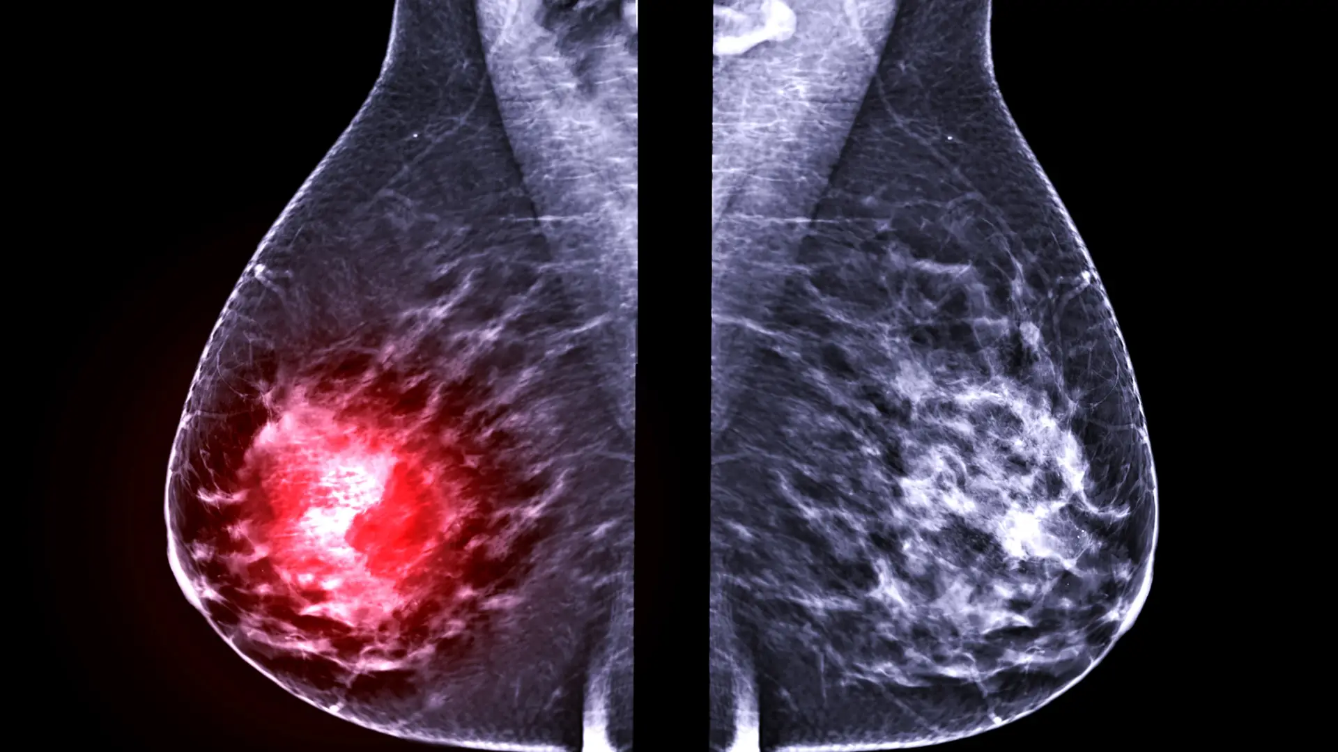 Mammogram imaging